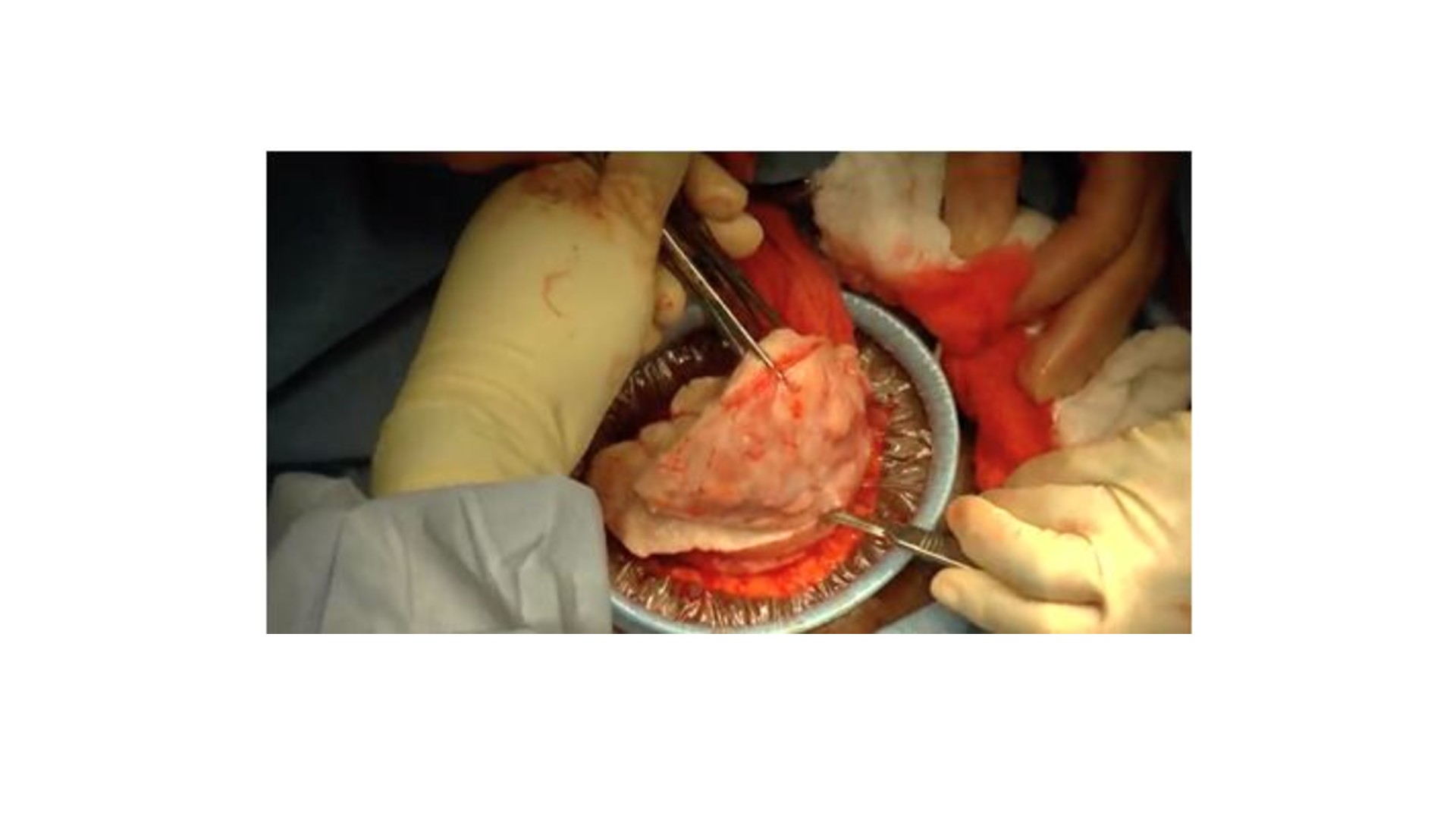 Ultra minilaparotomy myomectomy