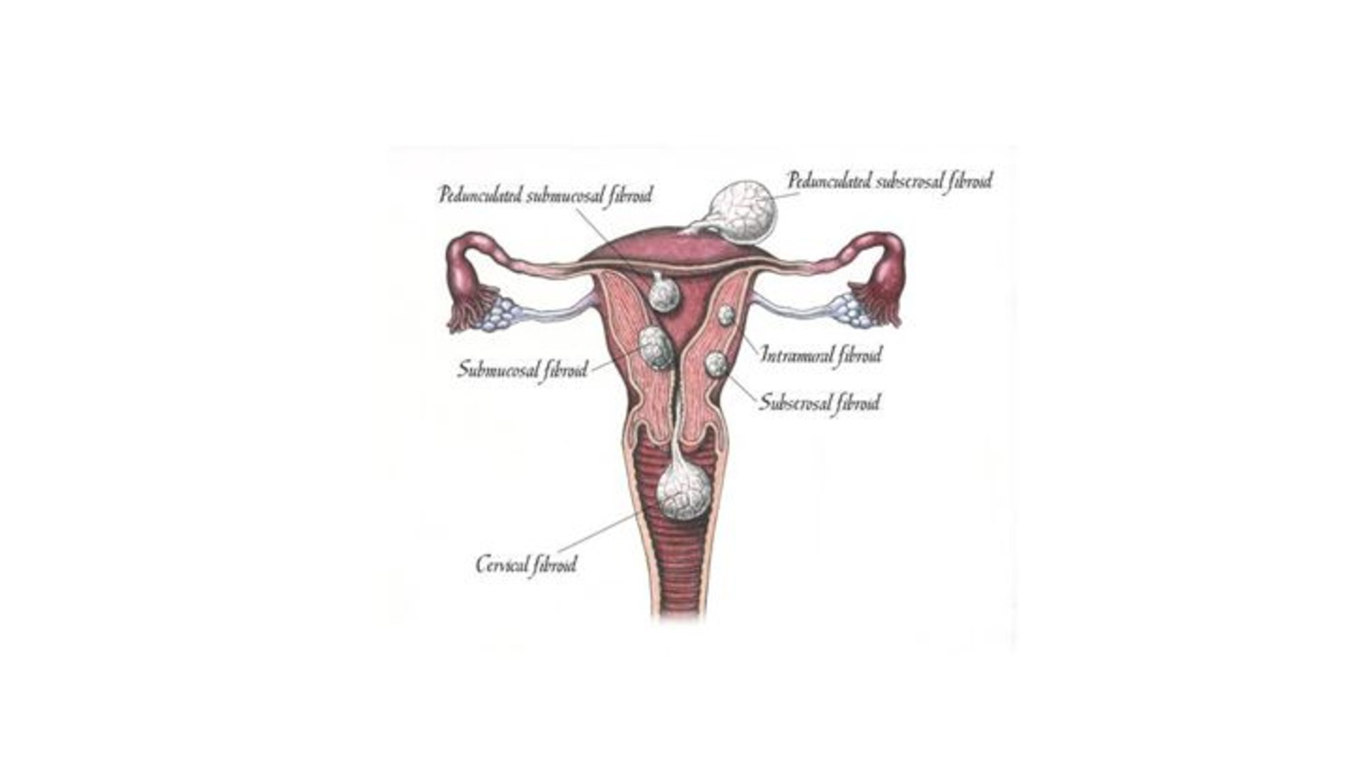 Vaginal Myomectomy