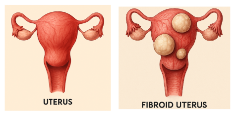 Laparoscopic Myomectomy: Expert Answers from a Fibroid Specialist