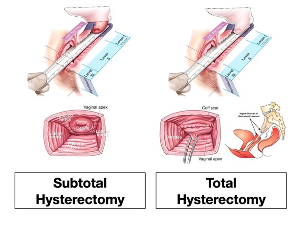 Total Hysterectomy vs. Supracervical Hysterectomy: Exploring the Differences and Pros/Cons
